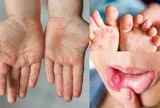 Cảnh báo bệnh tay chân miệng và sốt xuất huyết tiếp tục gia tăng, nhiều ca nặng
