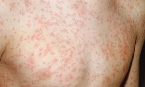 Ghi nhận 2 ca tử vong liên quan đến sởi