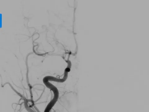 Cảnh báo đột quỵ não ở trẻ: Ca bệnh đánh thức sự chủ quan