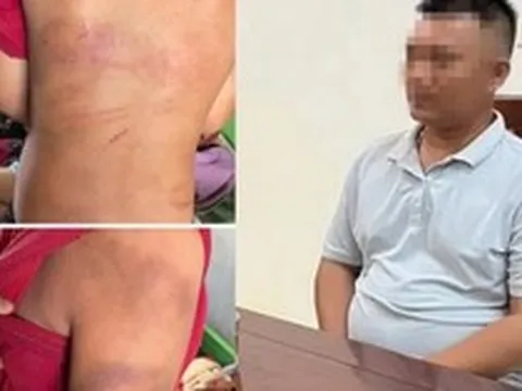 Vụ bé trai 10 tuổi người thâm tím nghi bị bạo hành: Lời khai của bố đẻ